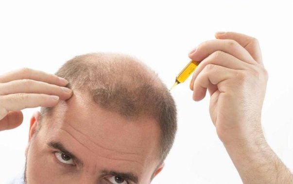 Man using a hair loss product