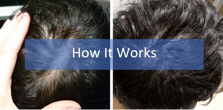 How Minoxidil works